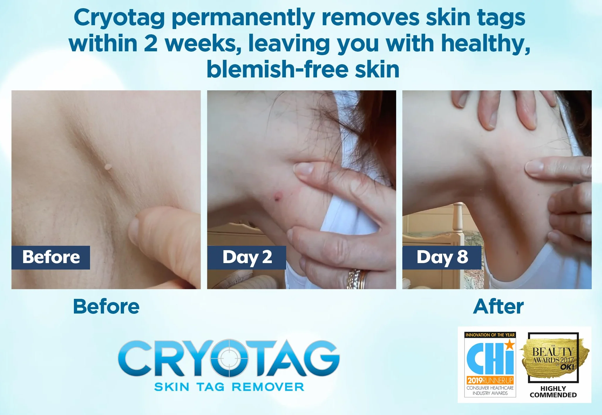 Cryotag Skin Tag Remover – Crioterapia per Rimozione Rapida Fibromi Penduli, 12 Trattamenti