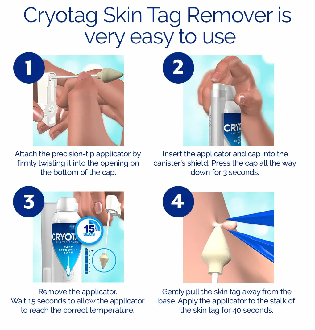 Cryotag Skin Tag Remover – Crioterapia per Rimozione Rapida Fibromi Penduli, 12 Trattamenti